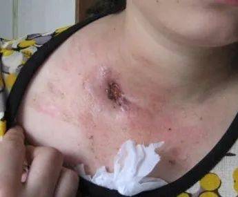 健康科普十说说肺外结核