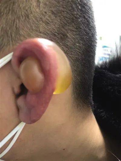 不知不觉冻坏耳朵内蒙古一医院一上午接诊6例冻伤患者