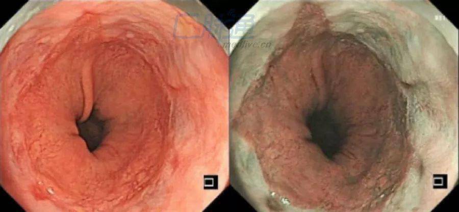 食道炎图片食道癌图片