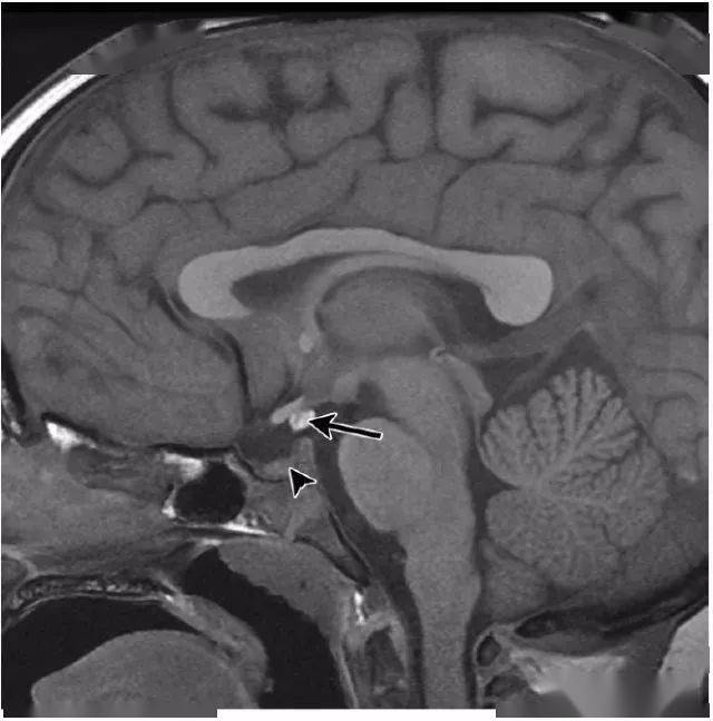 大脑中线处常见的25种疾病