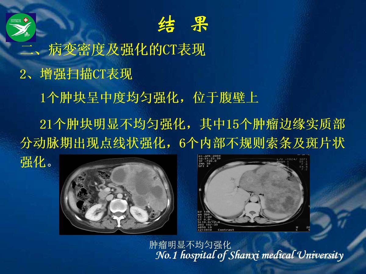 李健丁教授:胃肠道外间质瘤的ct表现和临床病理分析_影像