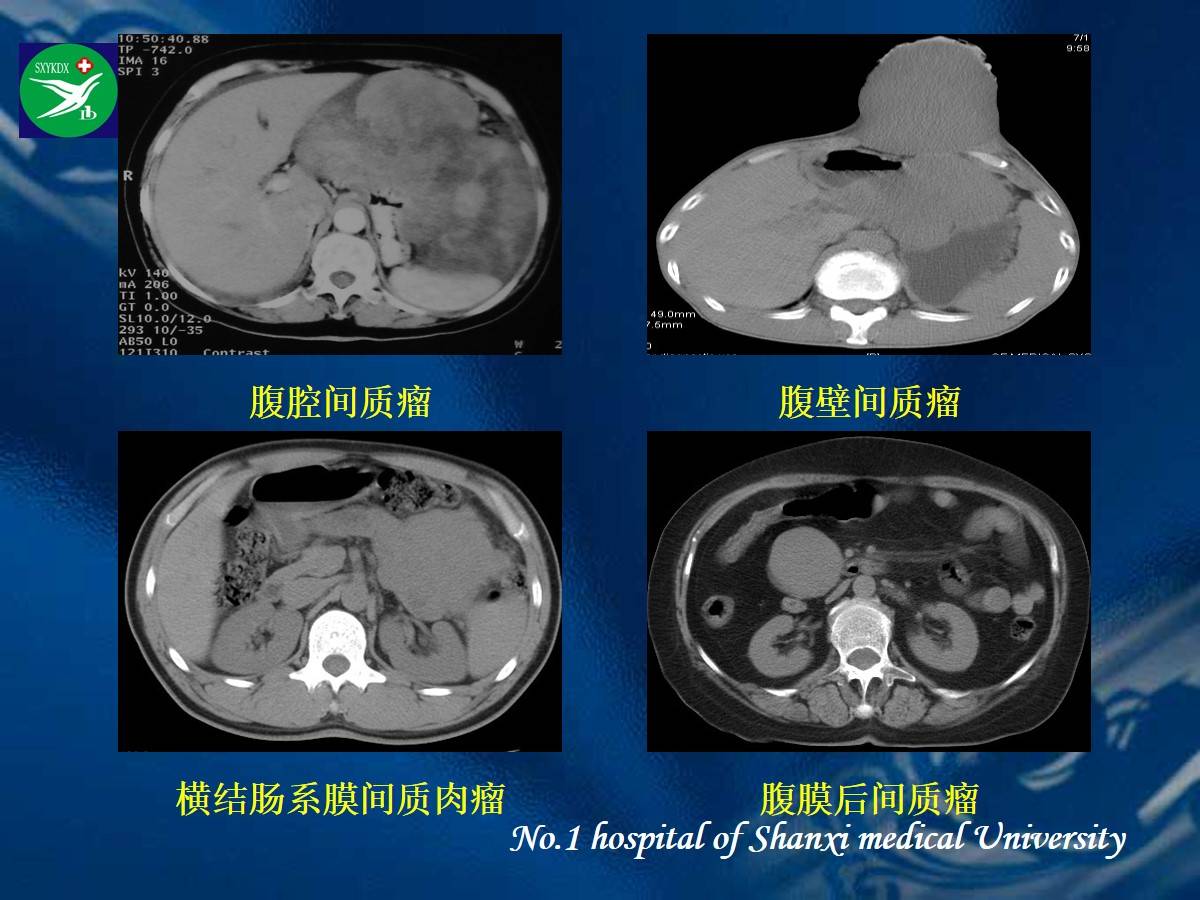 李健丁教授:胃肠道外间质瘤的ct表现和临床病理分析_影像