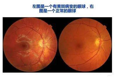 视力诚可贵黄斑价更高,这些症状是患上眼底病的绝对警告!