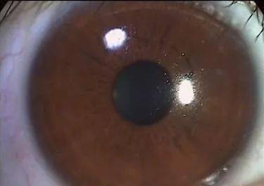 裂隙灯检查查什么