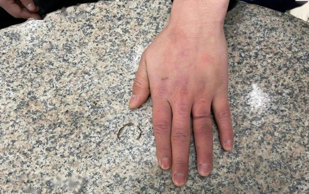 凭祥一男子戒指卡手"无法自拔" 消防员成功"破戒"