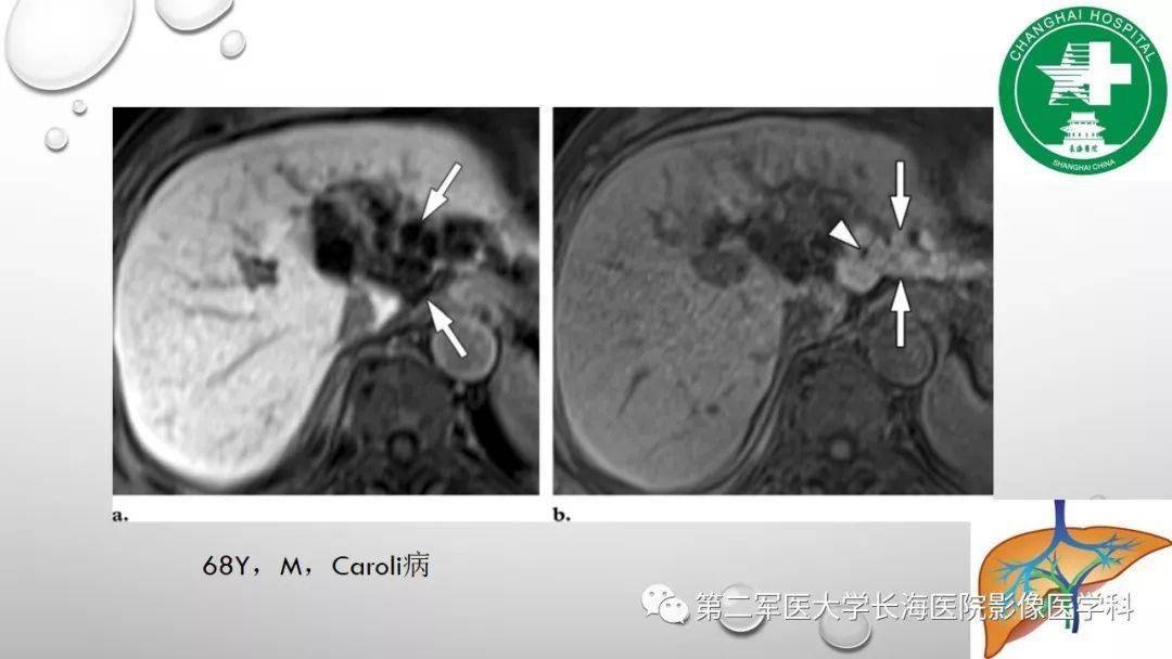 普美显丨肝胆特异性MRI对比剂-钆塞酸二钠Gd-EOB-DTPA_肝脏