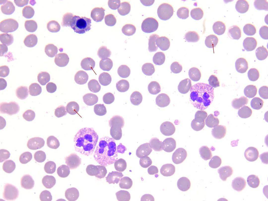 红细胞间隙一层粉尘感,如箭头所示 低倍镜(10×10)考虑到 mchc>380g/l