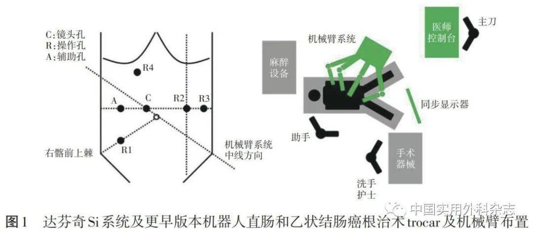 对于达芬奇si系统及更早版本,手术常用4～5枚trocar:镜头孔c,机械臂