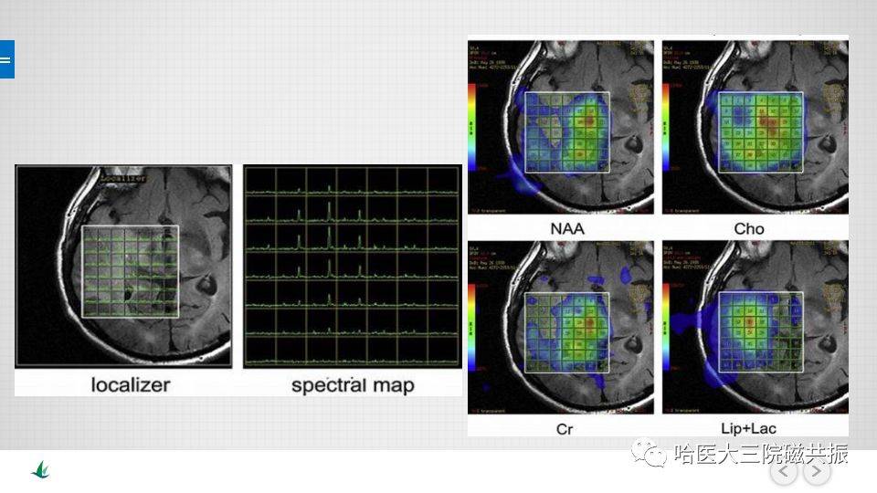磁共振波谱成像(mrs)的原理及临床应用