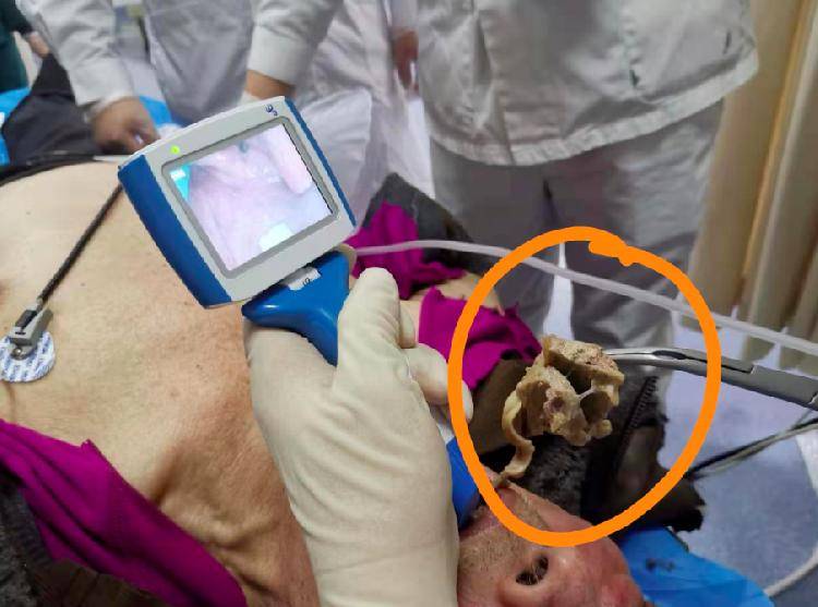 大块羊肉卡住8旬老人喉咙 重医大附三院急诊医生果断取异物挽救老人