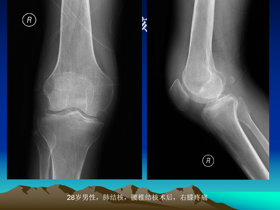 膝关节结核的影像学诊断