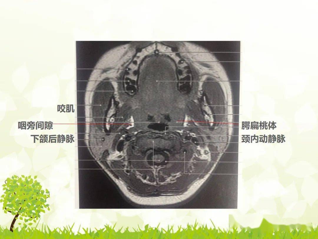 咽隐窝ct解剖图图片