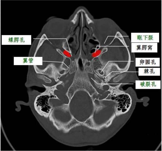 口腔外:翼上頜裂---顳下窩內:蝶顎孔---鼻腔後下:顎鞘管---鼻咽後上