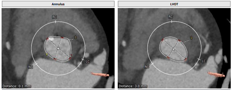 跨越横位心,攻克重度钙化,南大二附院吴延庆教授团队成功完成爱德华