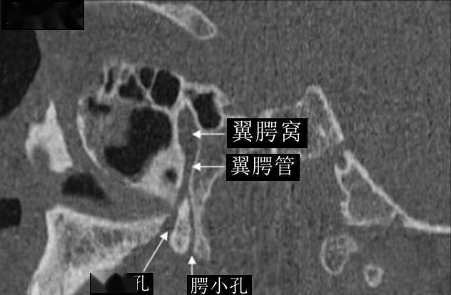 翼腭窝的ct影像解剖