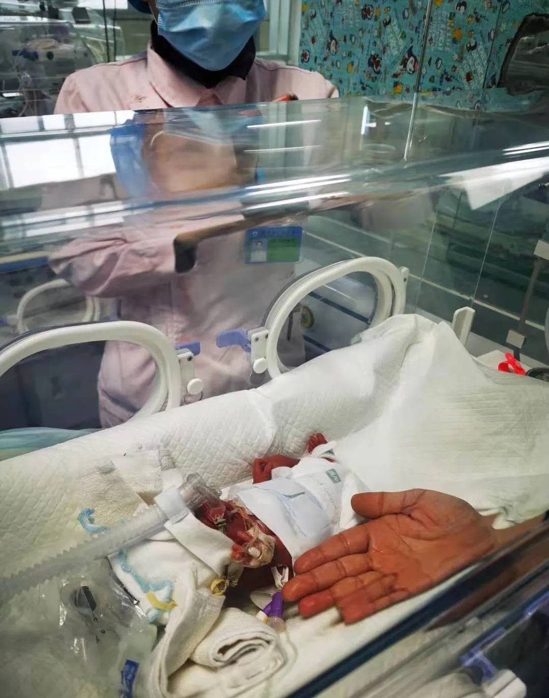 出生仅960克 四川阆中28周早产巴掌宝宝顺利出院