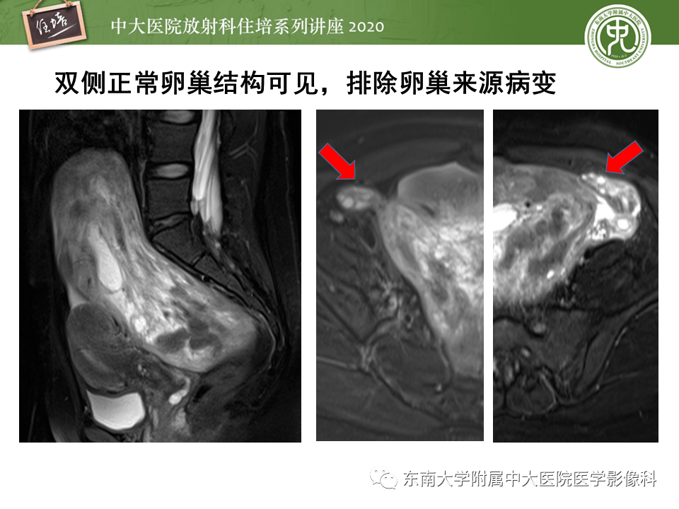 病變易與卵巢來源病灶混淆導致誤診,如子宮巨大漿膜下肌瘤,闊韌帶肌瘤