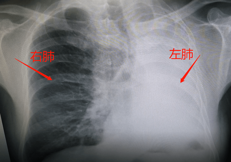 正常人的肺部图片真实图片