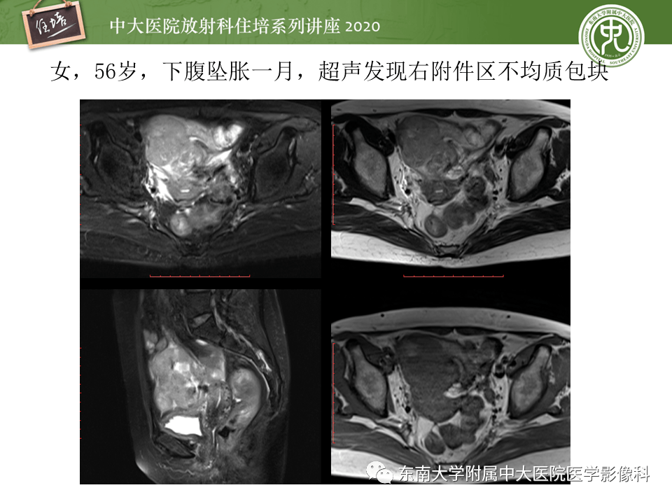 子宮來源:子宮來源宮旁病變易與卵巢來源病灶混淆導致誤診,如子宮巨大