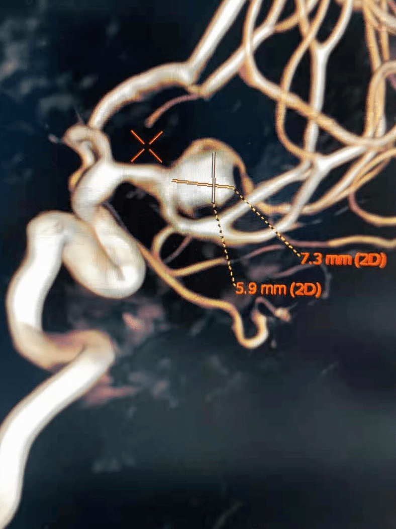 atlas病例集丨徐翔曲径通幽小身材大担当atlas支架在小直径血管内的