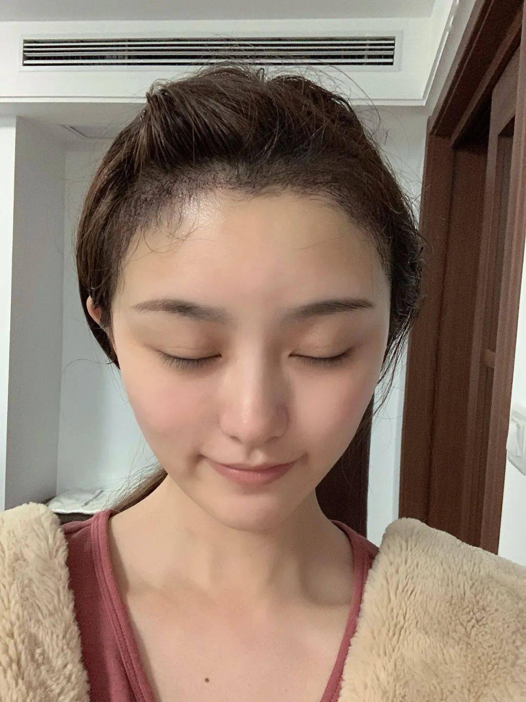我的植发日记植发一个月后