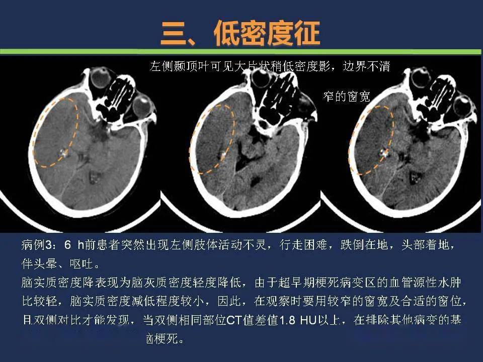 如何根据头颅ct预判超早期脑梗死