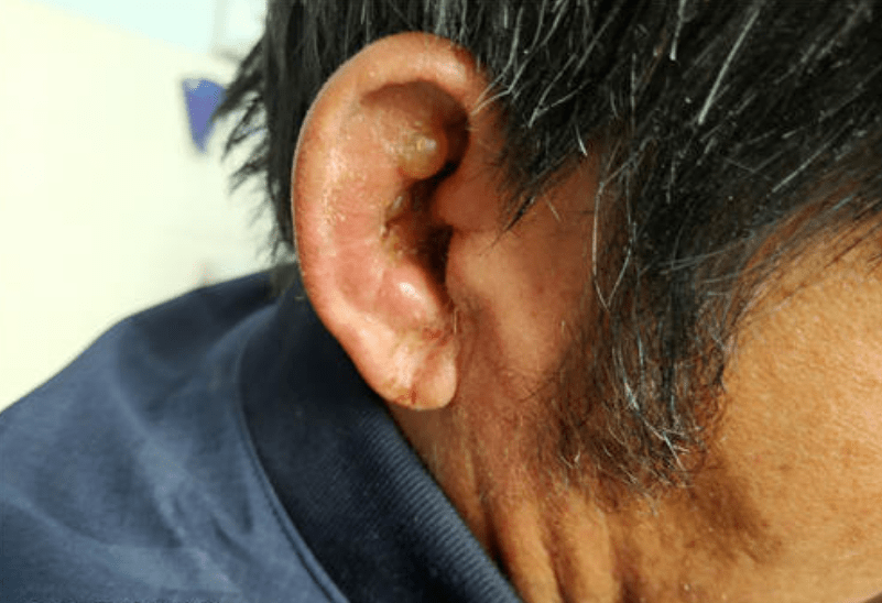 表现为鼓膜或外耳道疱疹,不同程度的伴有耳塞,耳鸣,耳痛及听力下降.