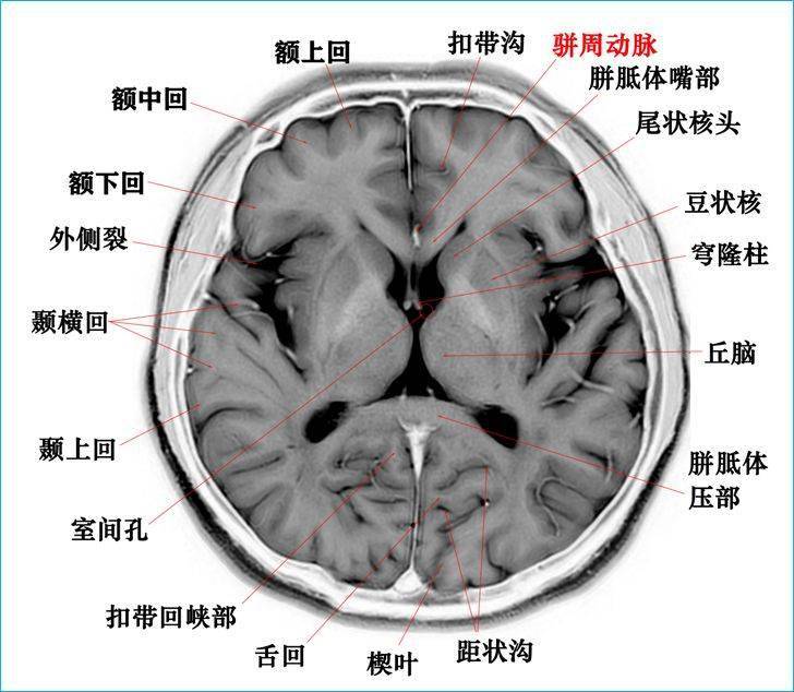 必收藏這個高清顱腦斷層解剖圖譜實在太棒了磁共振大體標本