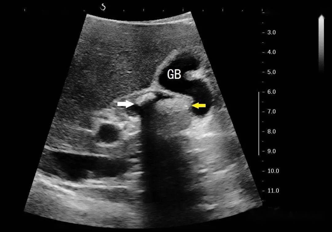 超声基础:两块胆囊结石后面的基础知识