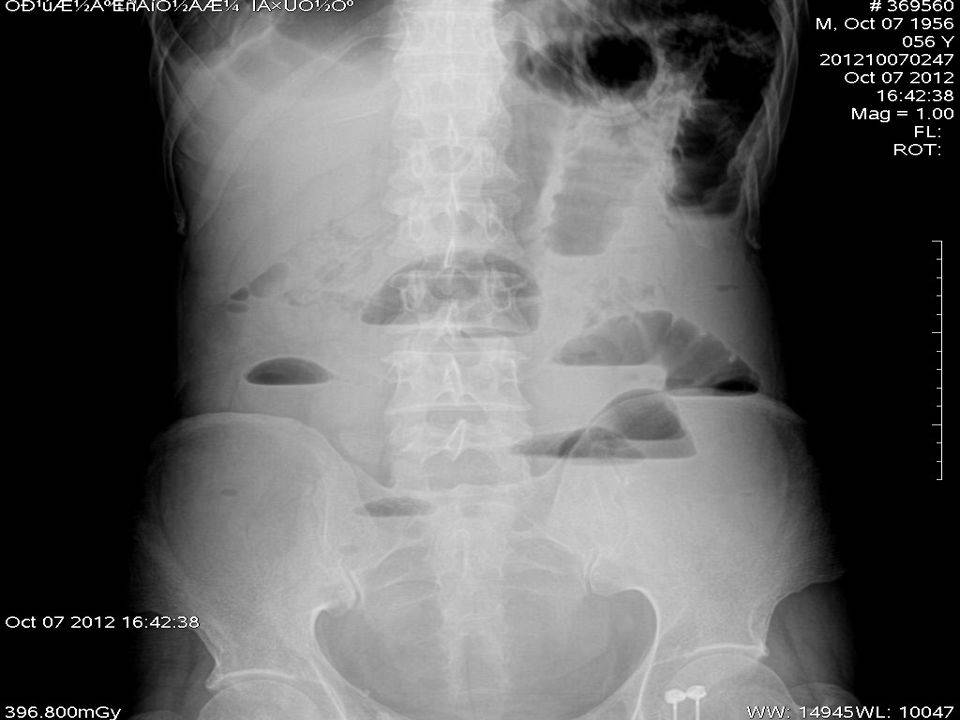 肠梗阻x线图片及报告图片