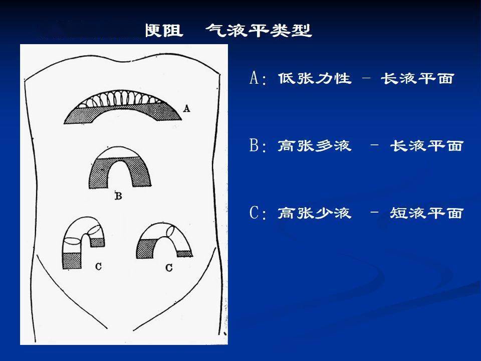 详细肠梗阻的分类及影像学表现高清图片文字讲解