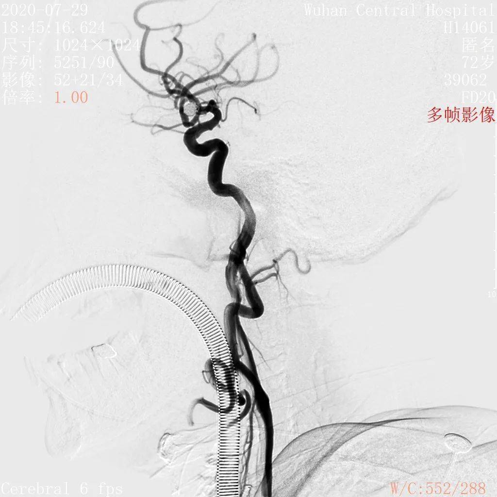 经scepter c球囊导管释放atlas支架球囊辅助后释放支架atlas向左滑动
