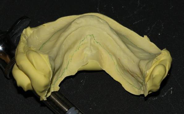 活动义齿怎么取下来 713aa3d37b1e4ce0bc0eb332cc1d3c20.jpeg