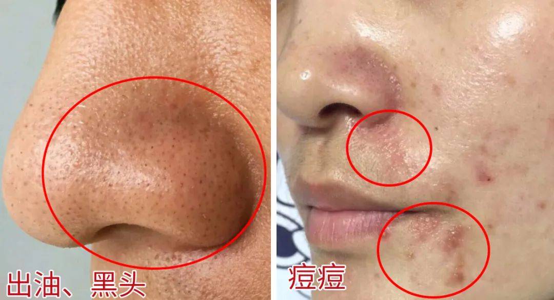 脸上挤出来的白条是什么竟然都是螨虫在作怪