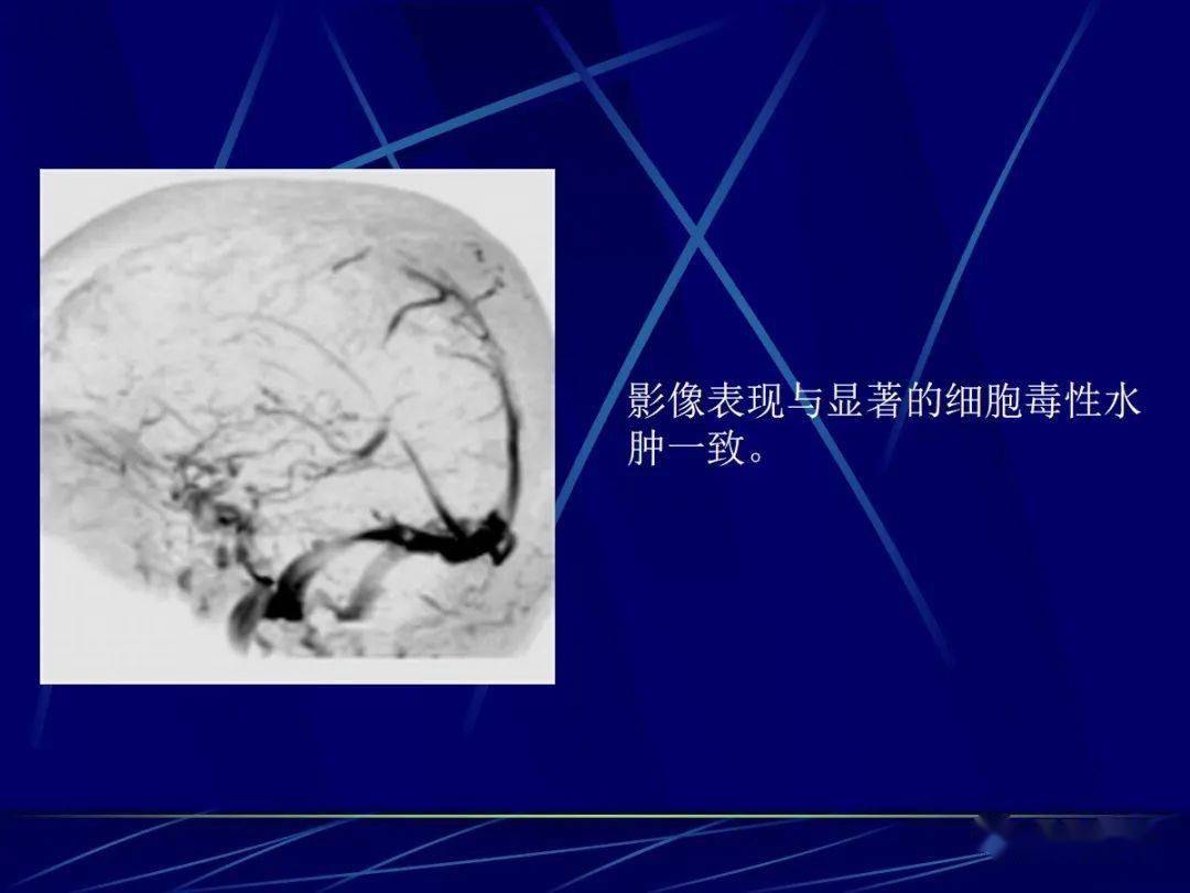 头颅mri中不同序列dwi和adc的区别