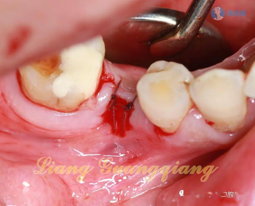 牙医学堂梁光强老师团队简单种植两例