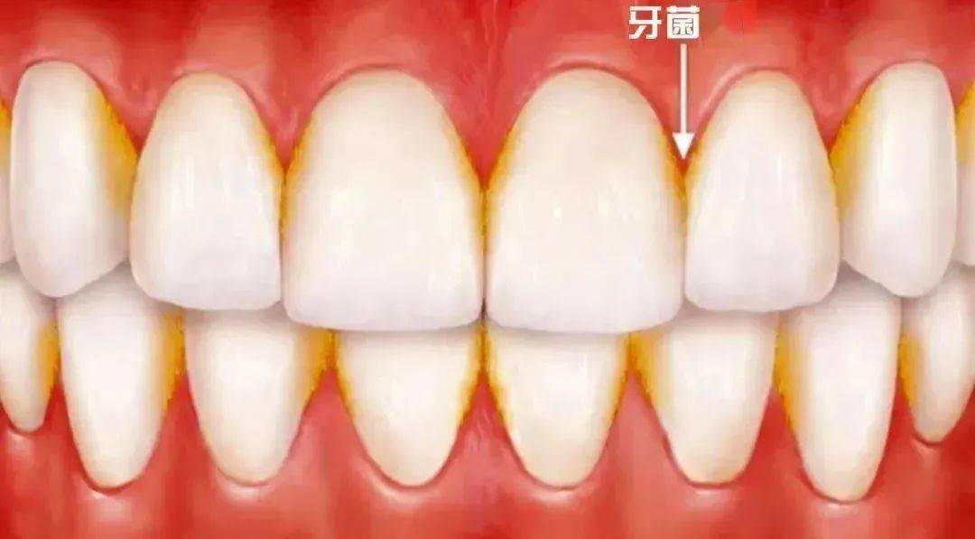 牙龈炎和牙周炎只有一字之差区别竟然这么大