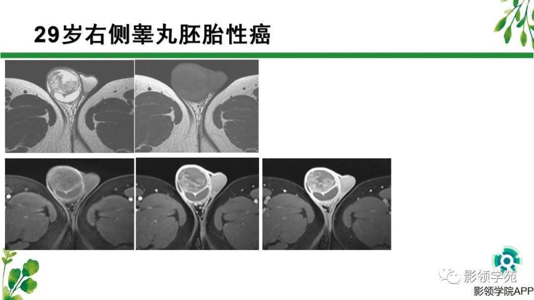 睾丸肿瘤mri诊断