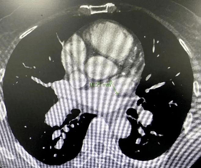 左心耳CT图片