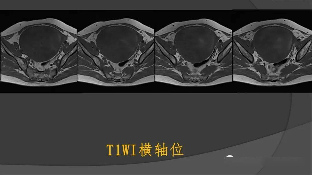 子宫丨子宫内膜癌肉瘤