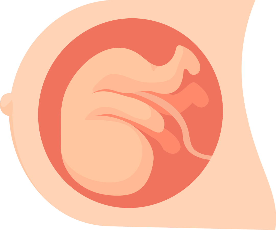 怀孕一个月自然流产的原因有哪些呢？怎么打胎好