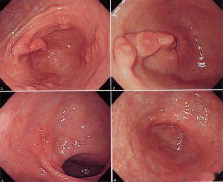 食管乳头状增生图片