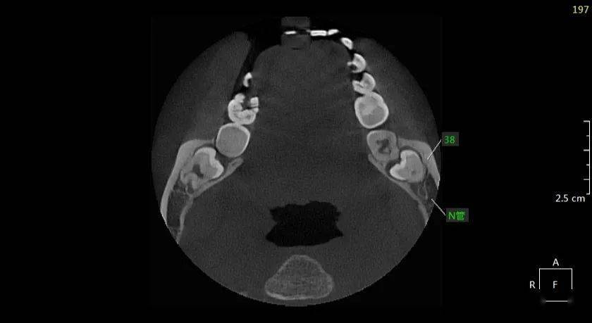 ct示:38倒置倾斜阻生,双根,牙冠距37远中根尖处较近,与下颌神经管上壁