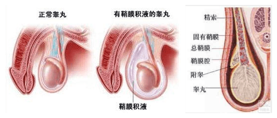 “蛋蛋”的烦恼之睾丸鞘膜积液