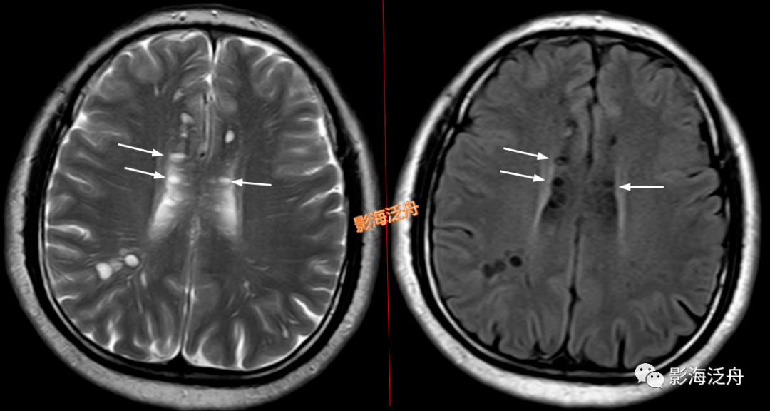 vr腔隙腔梗灶微出血脫髓鞘傻傻分不清快看這裡