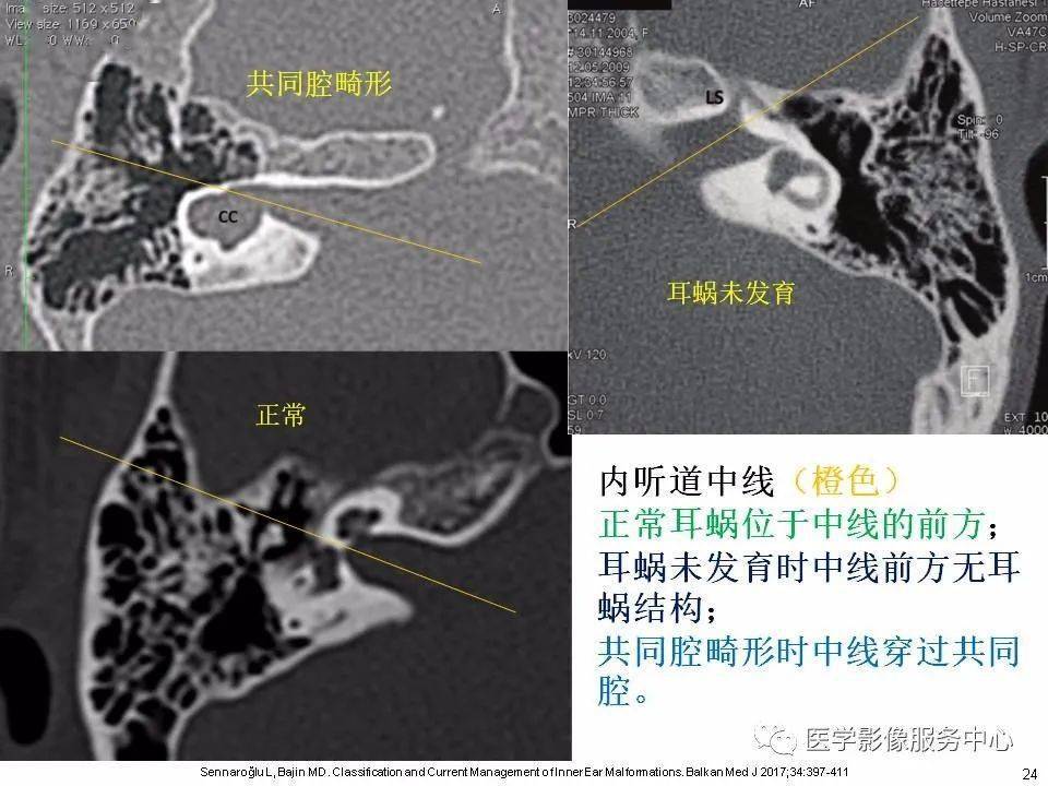 蜗神经异常,主要基于mri第二部分:内耳畸形分类,主要基于ct第一部分