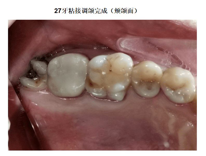 上颌第二磨牙颌面图图片