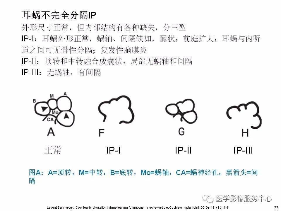 本文目錄 第一部分:耳蝸解剖 第二部分:內耳畸形分類,主要基於ct 第