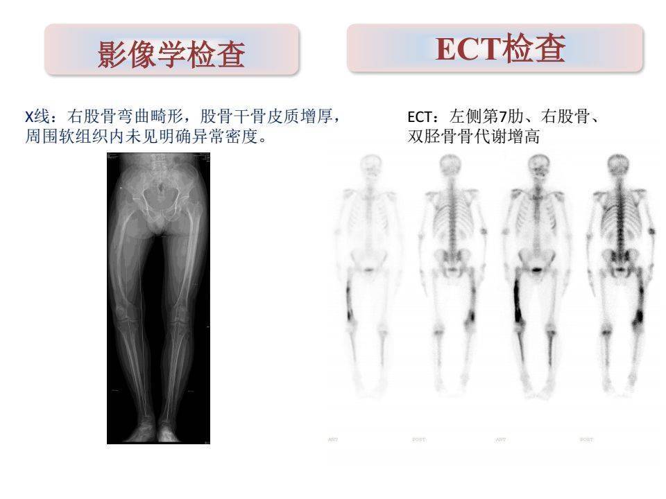 一文搞定paget骨病诊治详解