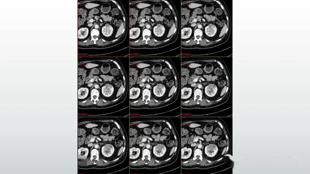 肾脏丨透明细胞癌